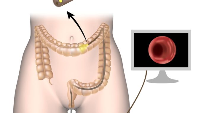kolonoskopia